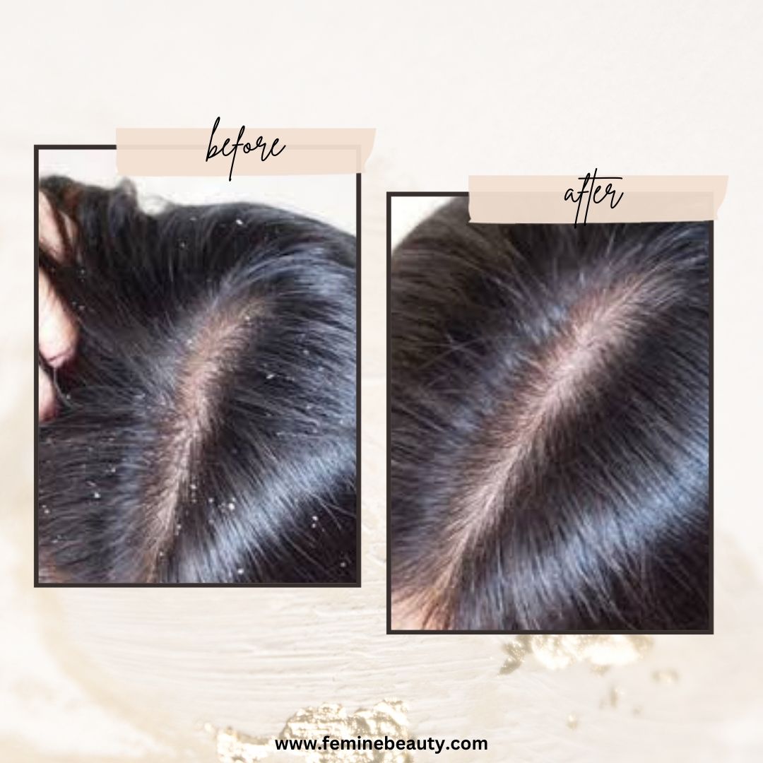 Scalp Massager
